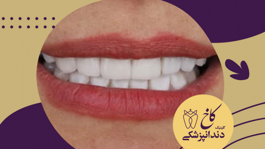 پرسلن لامینت و ونیر کامپوزیت کلینیک دندانپزشکی کاخ