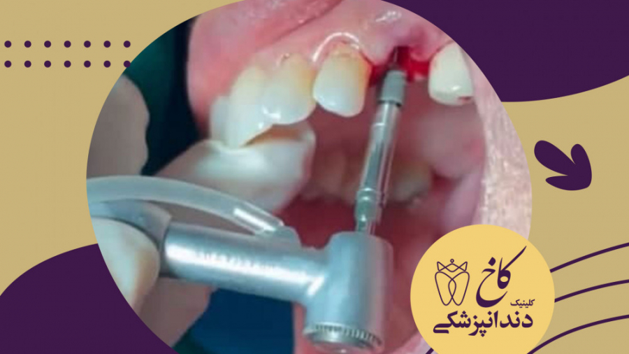 ایمپلنت فوری کلینیک دندانپزشکی کاخ