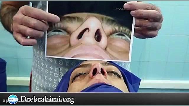 جراحی زیبایی بینی استخوانی توسط دکتر امید ابراهیمی دکتر امید ابراهیمی