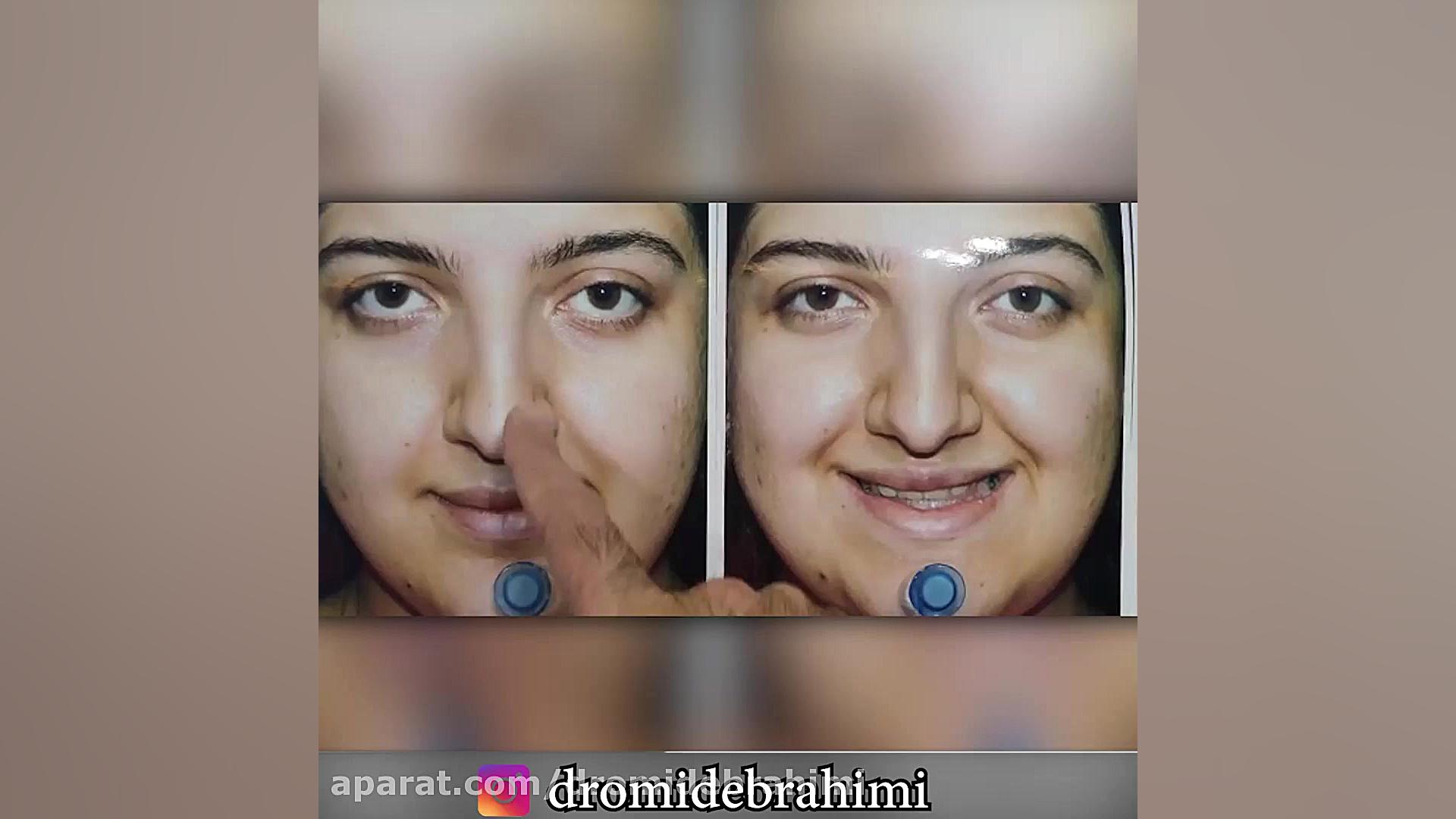 جراحی زیبایی بینی توسط دکتر امید ابراهیمی بهترین جراح بینی در تهران دکتر امید ابراهیمی