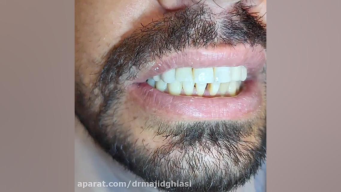 اصلاح لبخند فک بالا با روکش های FPM دکترمجیدقیاسی