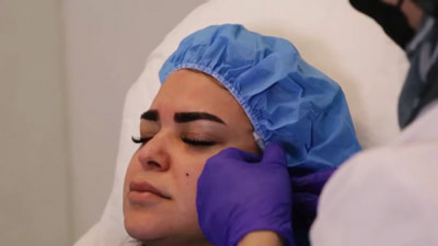 فیلم كانتورينگ صورت مراجعه کننده عزيزمون از قطر دکتر سوسن احمدی پیر شهید