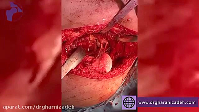 شکستگی استابولوم یا کاسه لگن و درمان آن کوبی برایانت