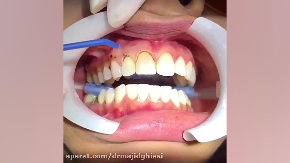 لیفت لثه دکترمجیدقیاسی