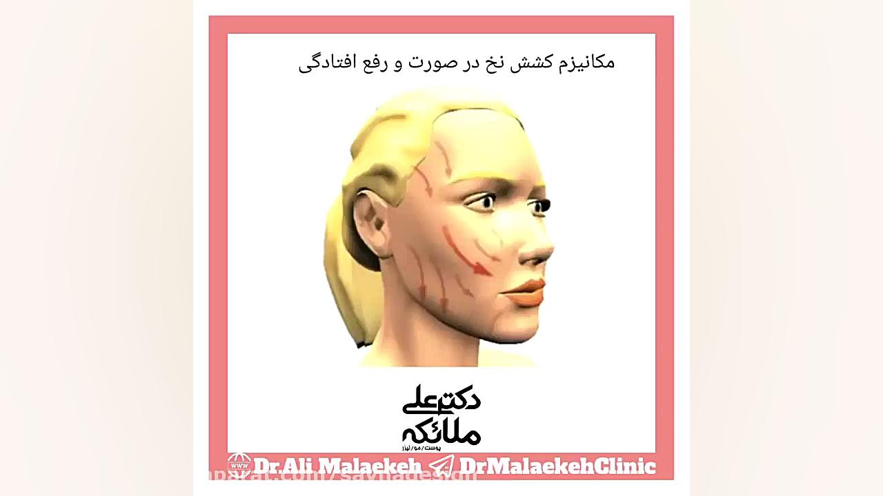 مکانیزم کشش صورت با لیفت و نخ اصلاح فرم صورت