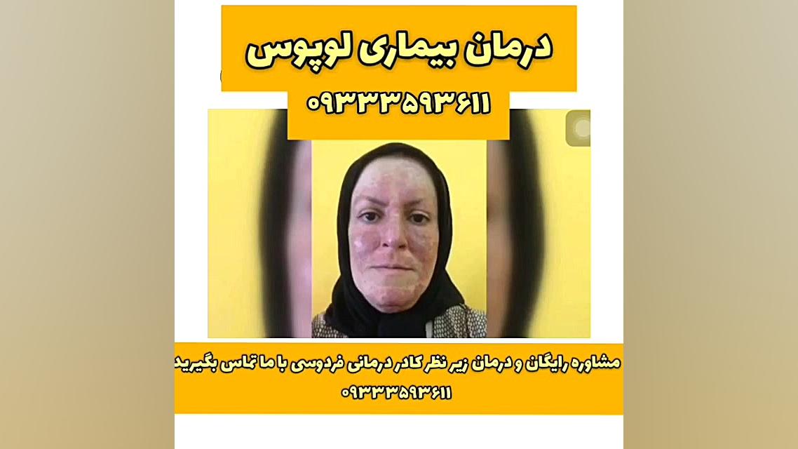 درمان لوپوس ترمیم سوختگی