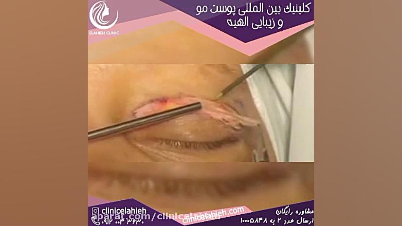 جراحی پف چشم توسط بهترین دکتر در تهران تست دفع سدیم ادرار