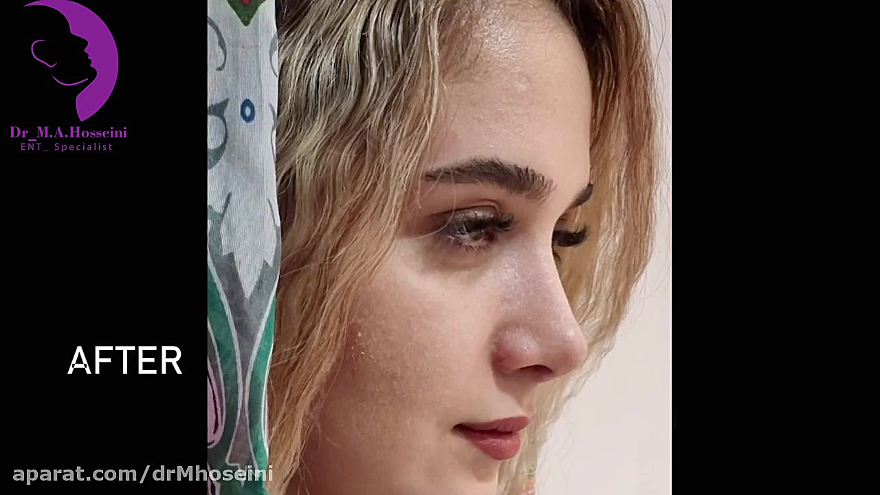 جراحی بینی بدون بیهوشی کلونیک اسپاسم