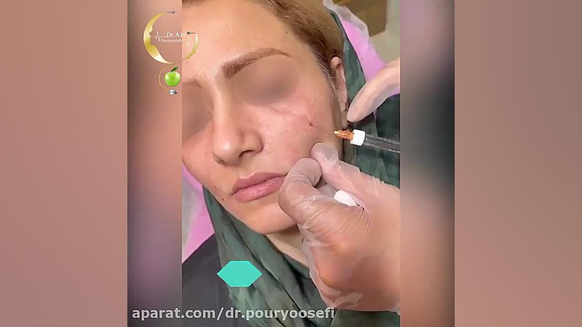 فیلم واقعی تزریق ژل زیر چشم جراحی پف زیر چشم