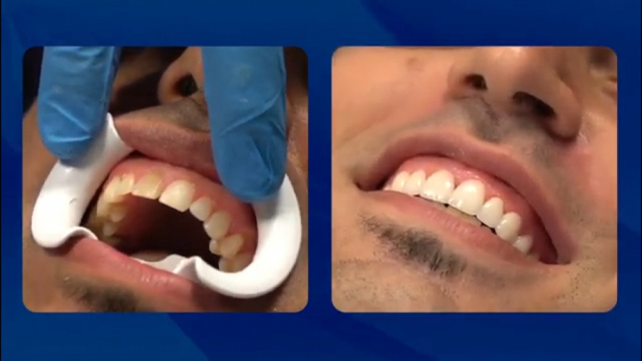 فیلم لومینیرز دندان (لمینت و روکش بدون تراش دندان) رتروگناتیا