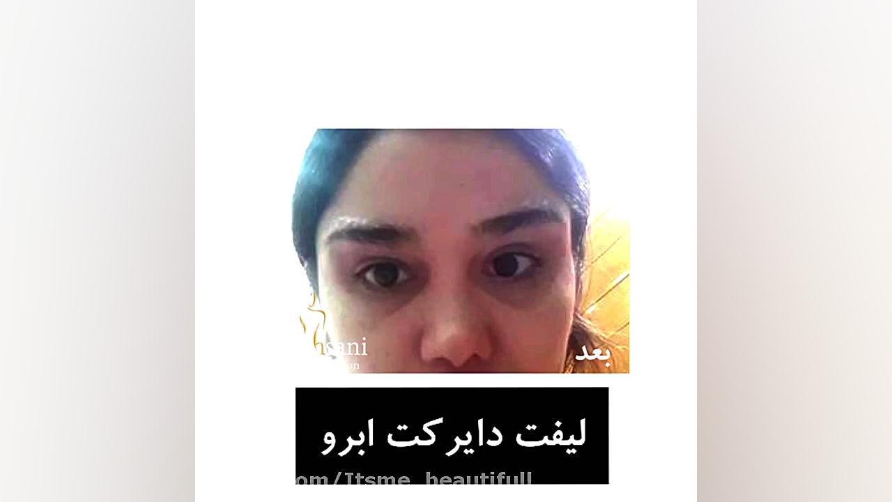 جراحی دایرکت ابرو،لیفت ابرو هایپوپاراتیروئیدیسم