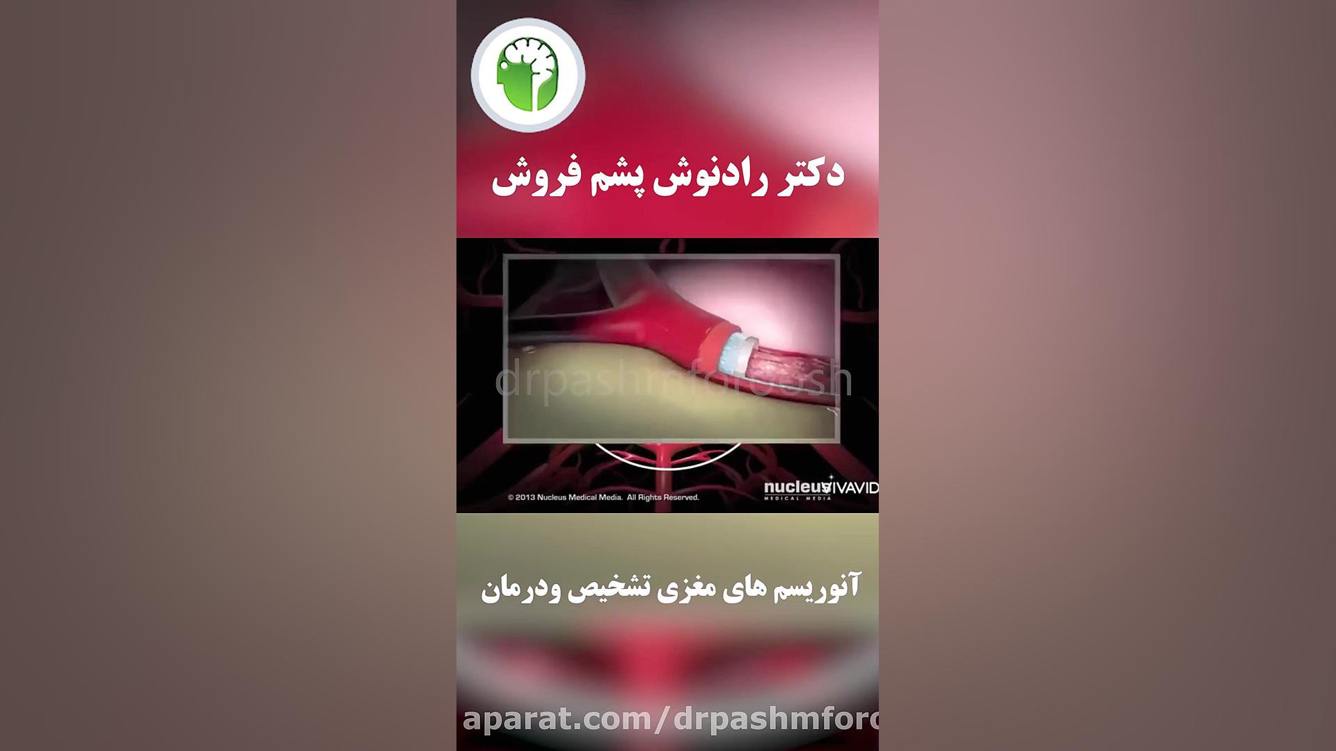جراحی بسته انوریسم های مغزی کربوکسی تراپی