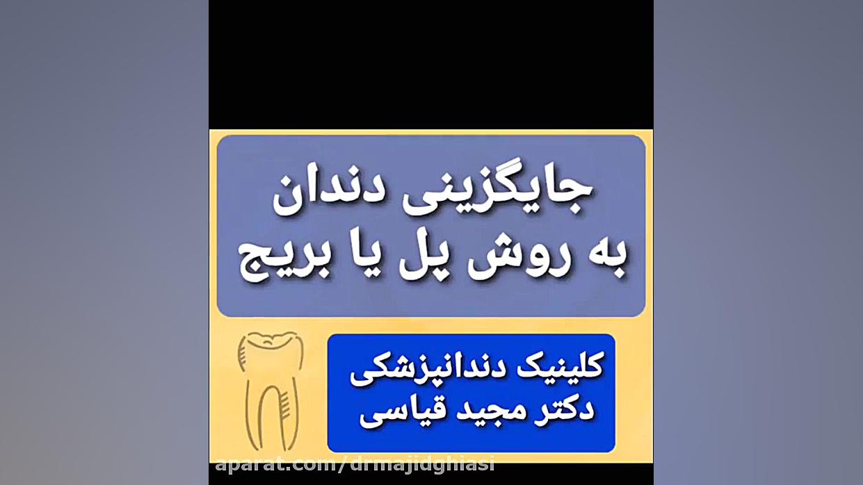 جایگزینی دندان بوسیله پل یا بریج دکترمجیدقیاسی