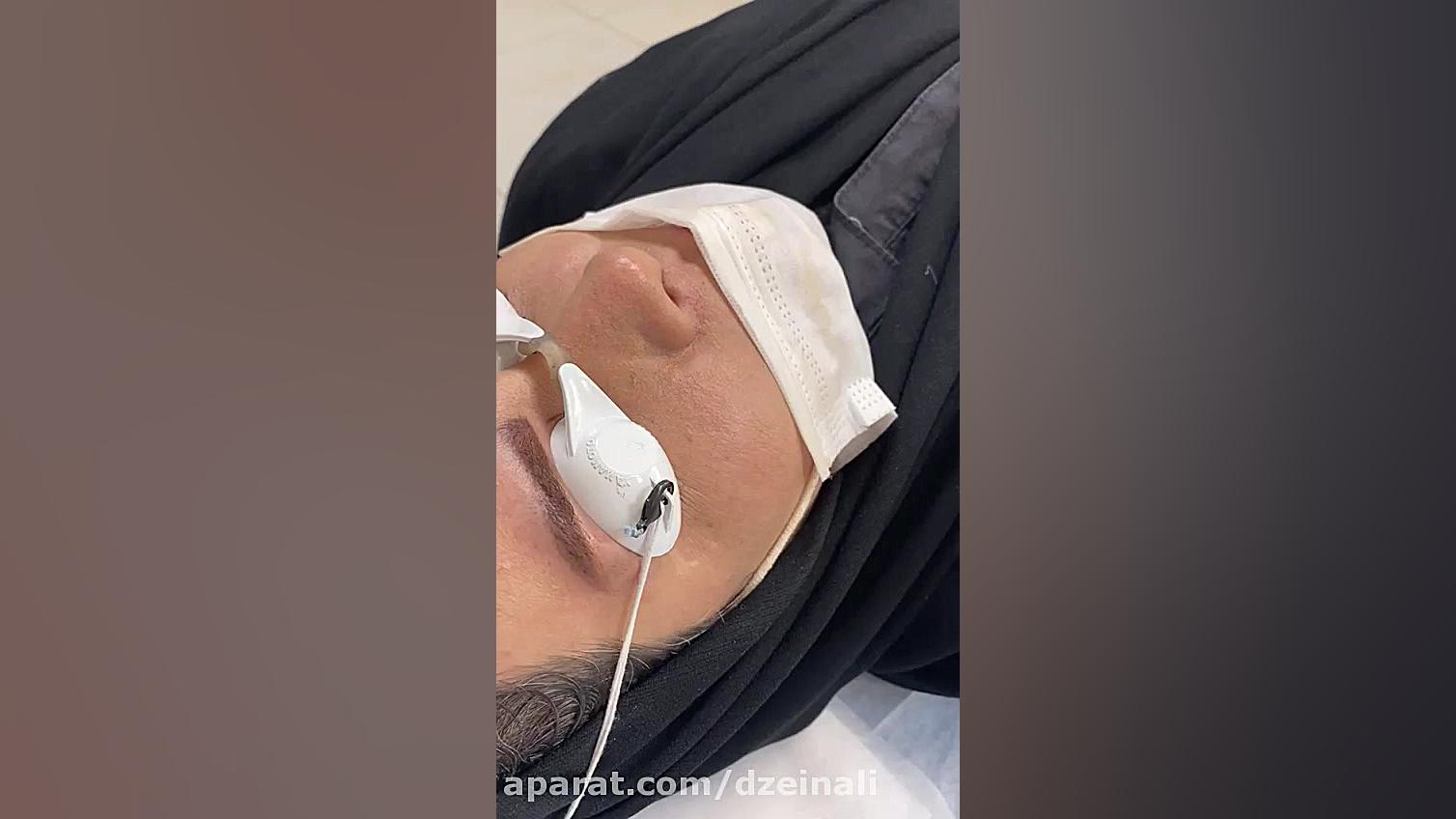 نتیجه عالی یک جلسه تزریق چربی صورت دکتر فرحناز زینعلی - متخصص پوست، مو، زیبایی زنجان