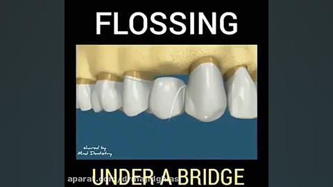 نخ دندان در بریج دکترمجیدقیاسی