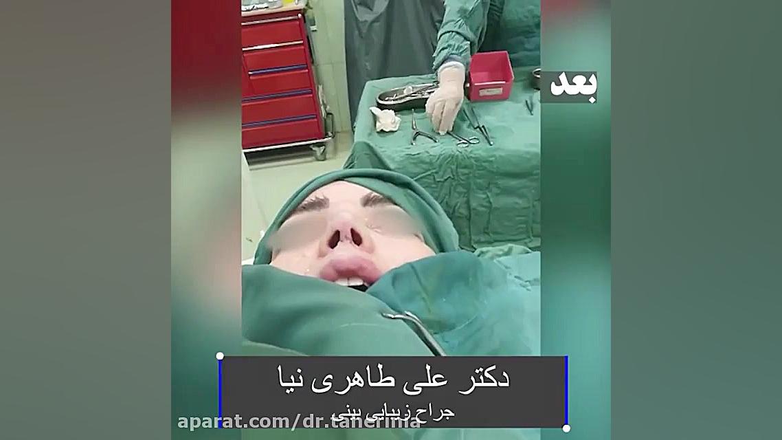 فیلم واقعی عمل جراحی بینی در اتاق عمل توسط دکتر علی طاهری نیا هایفوتراپی