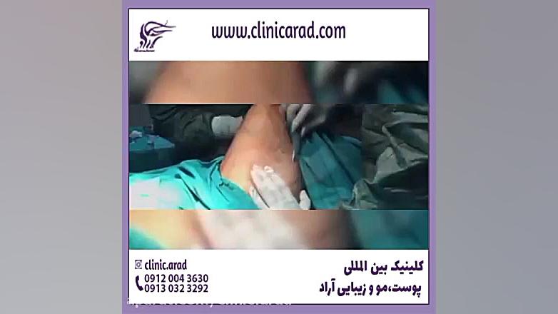 همه چیز در خصوص تزریق چربی اس وی اف ژل به باسن Northern Blot