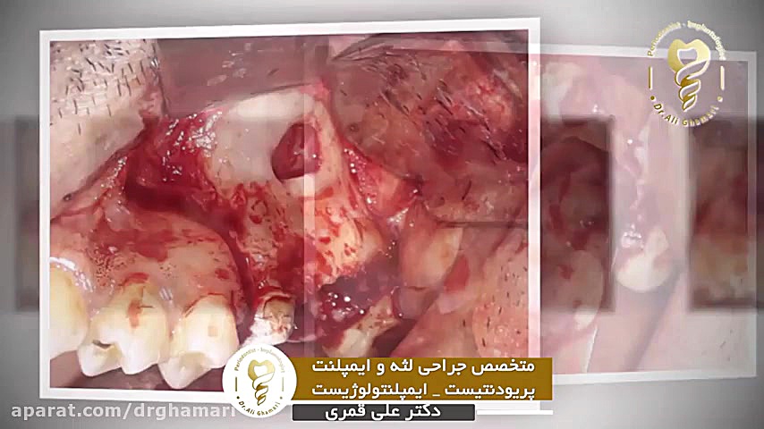 فیلم واقعی جراحی ایمپلنت دندان همزمان با سینوس لیفت دکتر علی قمری - متخصص جراحی لثه و ایمپلنت