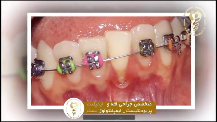 فیلم جراحی پیوند لثه ۶ دندان در فک پایین دکتر علی قمری - متخصص جراحی لثه و ایمپلنت