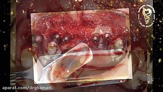 فیلم واقعی ایمپلنت ۴ دندان فک بالا و بازسازی استخوان با پی آر اف هایپوپاراتیروئیدیسم