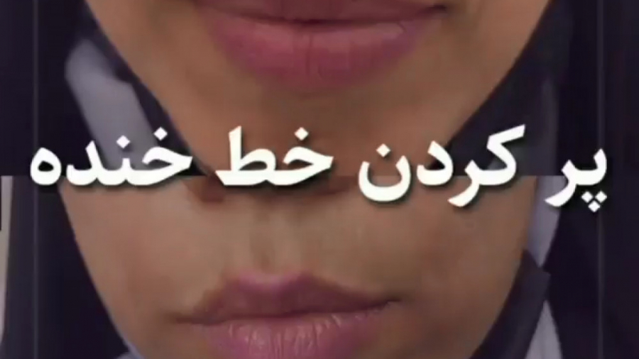 فیلم تزریق ژل خط خنده دکتر حمیده آقایی