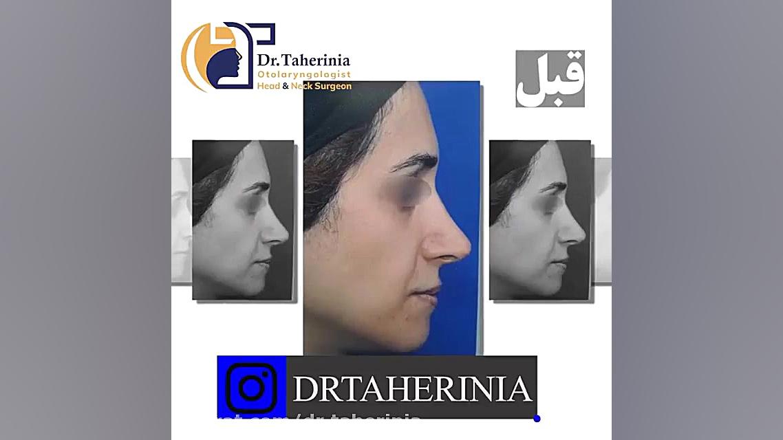 فیلم واقعی جراحی ترمیم بینی در اتاق عمل تزریق ژل