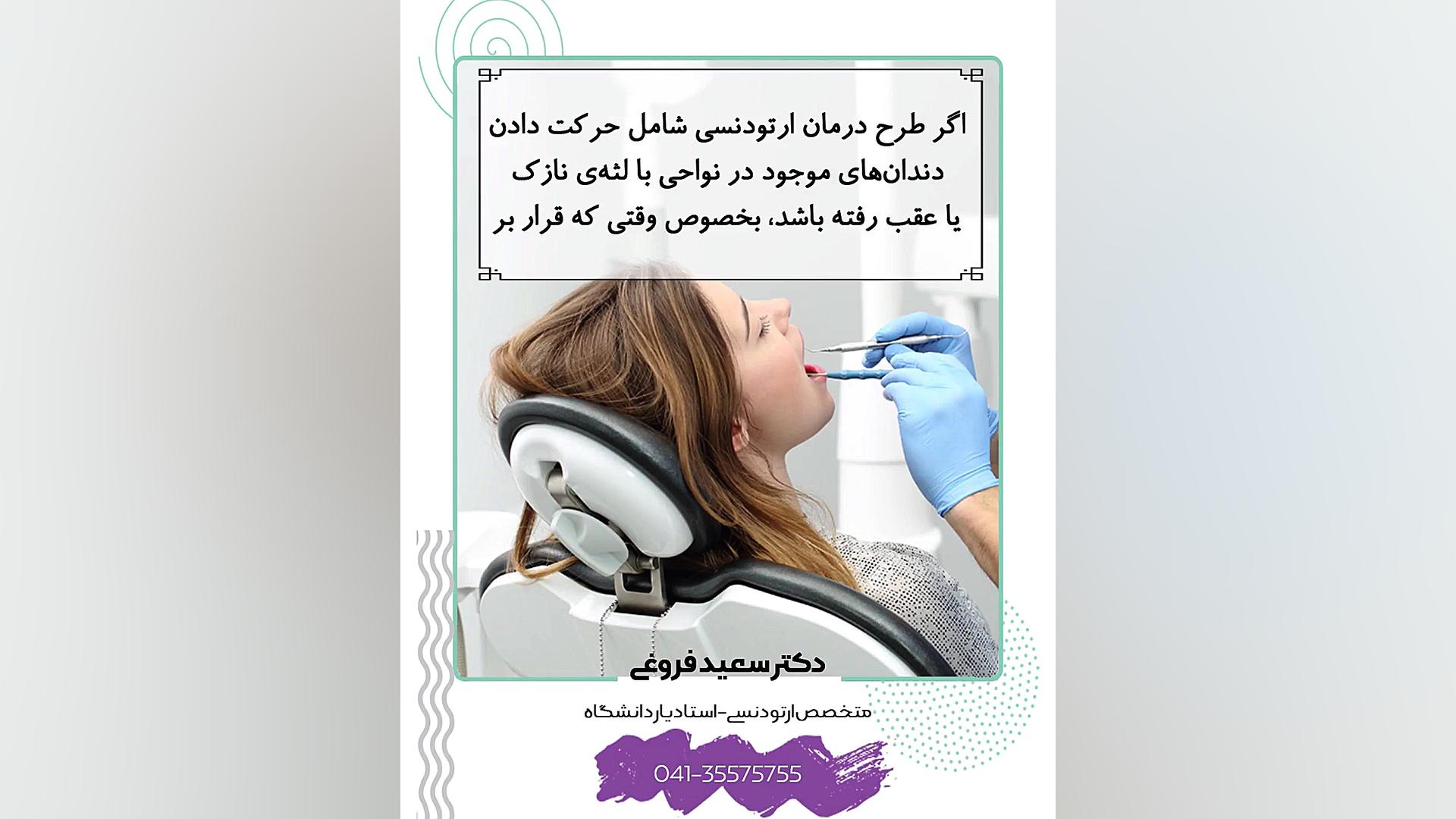 نیاز به پیوند لثه قبل از انجام ارتودنسی دکتر سعید فروغی متخصص ارتودنسی