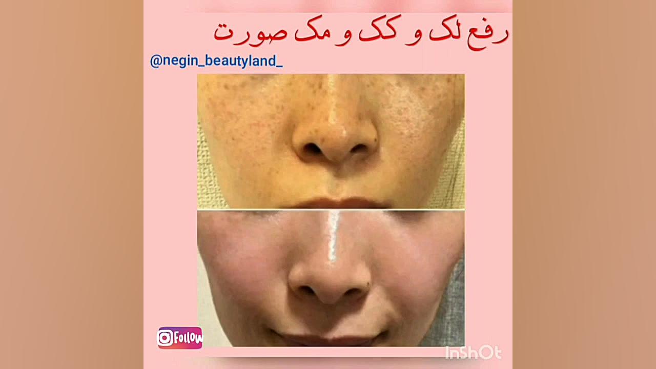 درمان لک و کک و مک صورت درمان ریزش مو