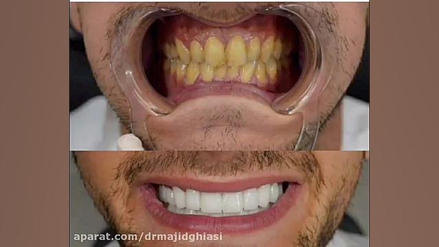 ۲۰ واحد لمینت دندان دکترمجیدقیاسی