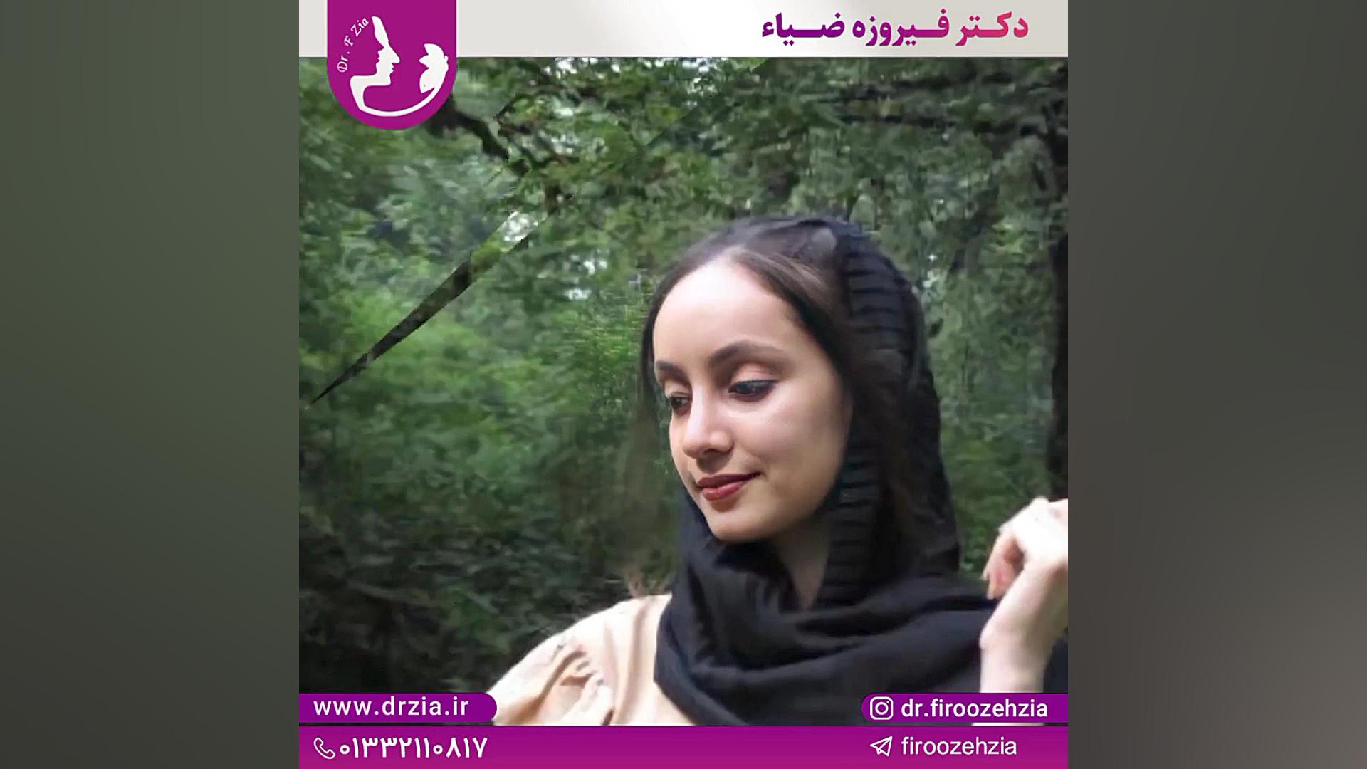 سه ماه پس از جراحی بینی توسط دکتر فیروزه ضیاء متخصص گوش و حلق و بینی عمل زیبایی