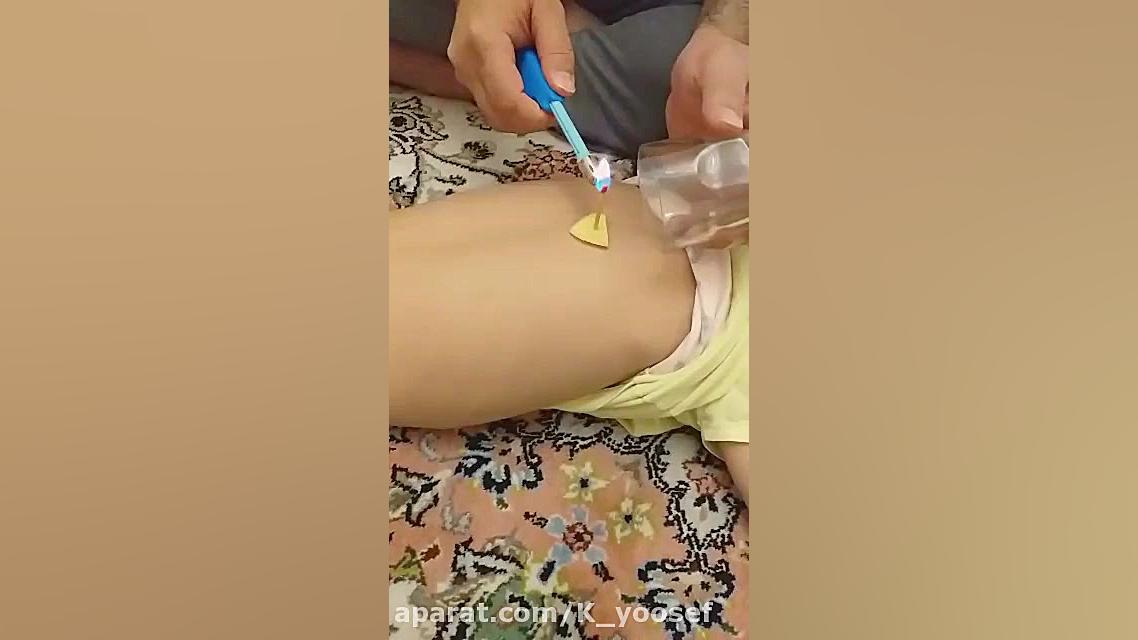 آموزش ساده بادکش گرم برای مشکلات ریه و کرونا مرغ طوفان