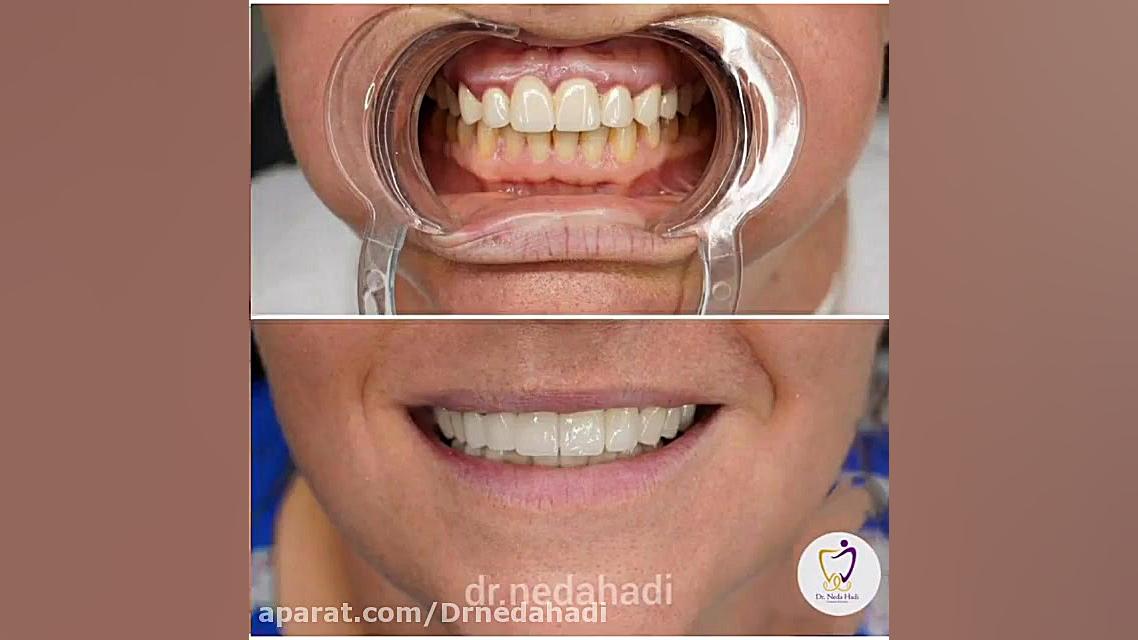 فیلم واقعی تعویض روکش های قدیم و جایگزینی روکش های زیبایی دکتر ندا هادی-دندانپزشک زیبایی