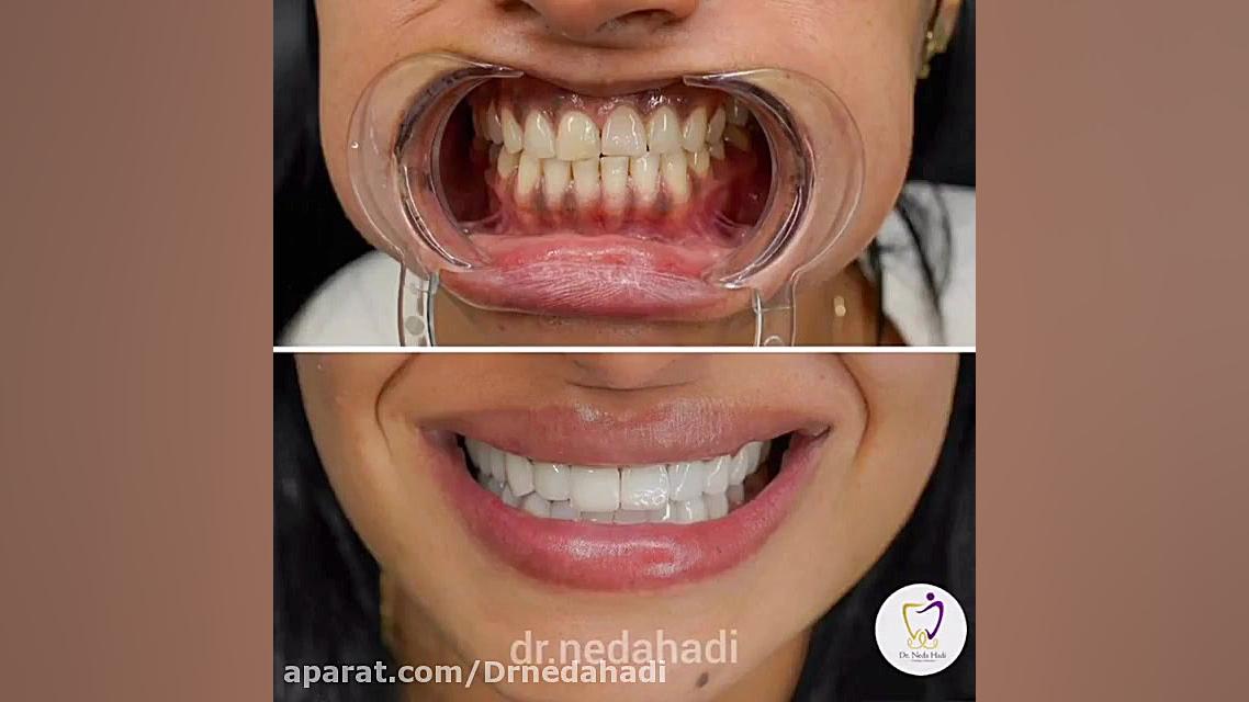 با انجام این روش دندان های خود را زیباتر کنید دکتر ندا هادی-دندانپزشک زیبایی
