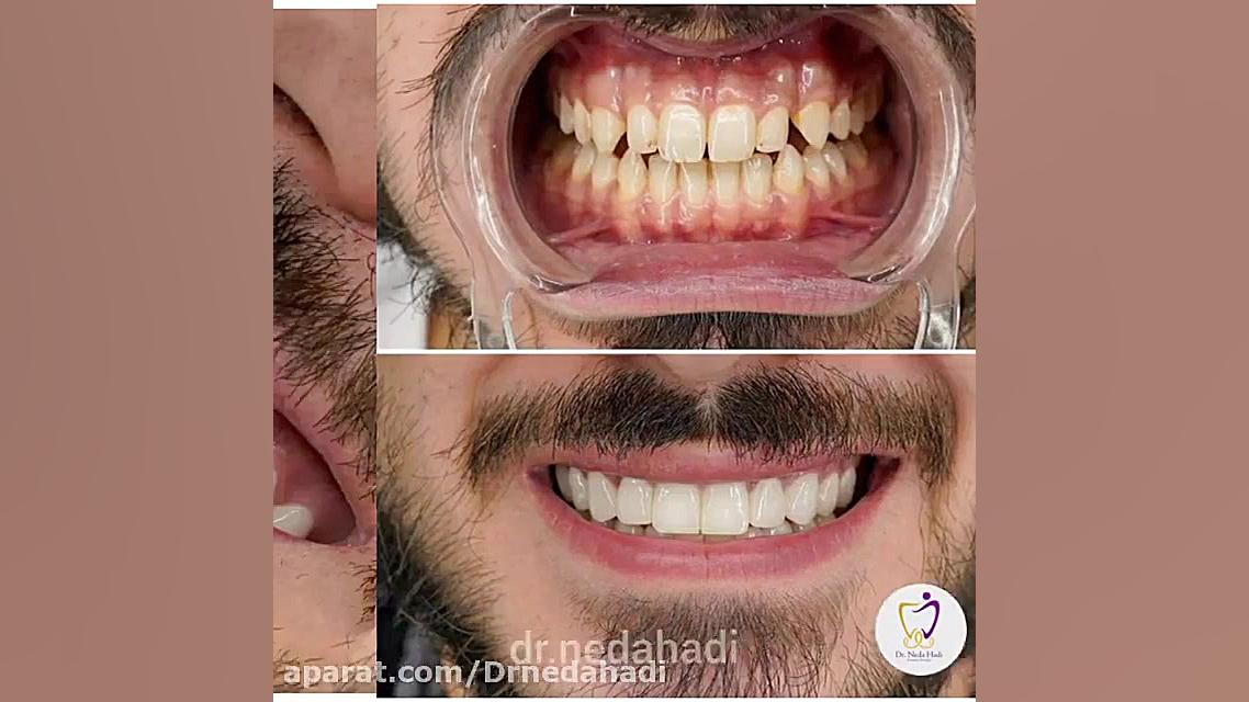 فیلم واقعی از انجام کامپوزیت ونیر دکتر ندا هادی-دندانپزشک زیبایی