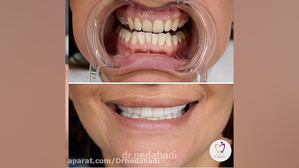 انجام کار 20 واحد لمینت در مطب دکتر ندا هادی دکتر ندا هادی-دندانپزشک زیبایی