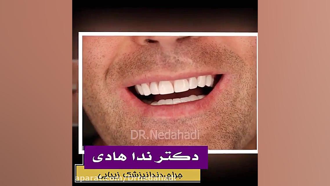آیا می دانید کامپوزیت ونیر دندان چگونه انجام می شود؟ دکتر ندا هادی-دندانپزشک زیبایی