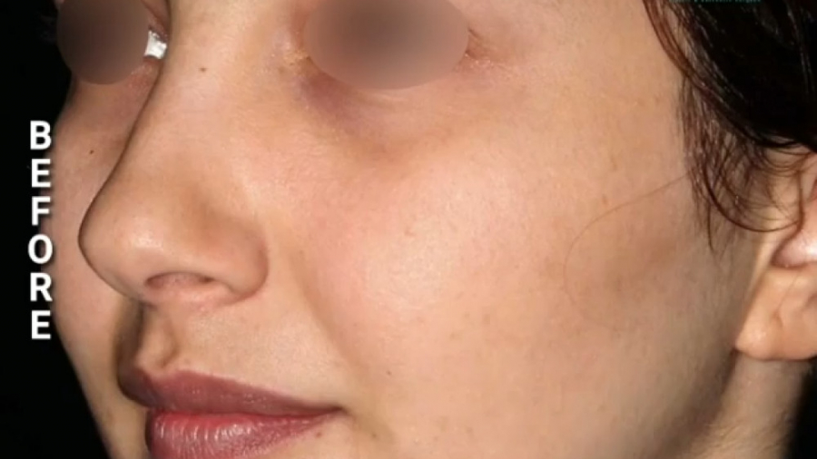 جراحی بینی نیمه فانتزی دکتر محمدرضا آخوندی نسب-فوق تخصص جراحی پلاستیک