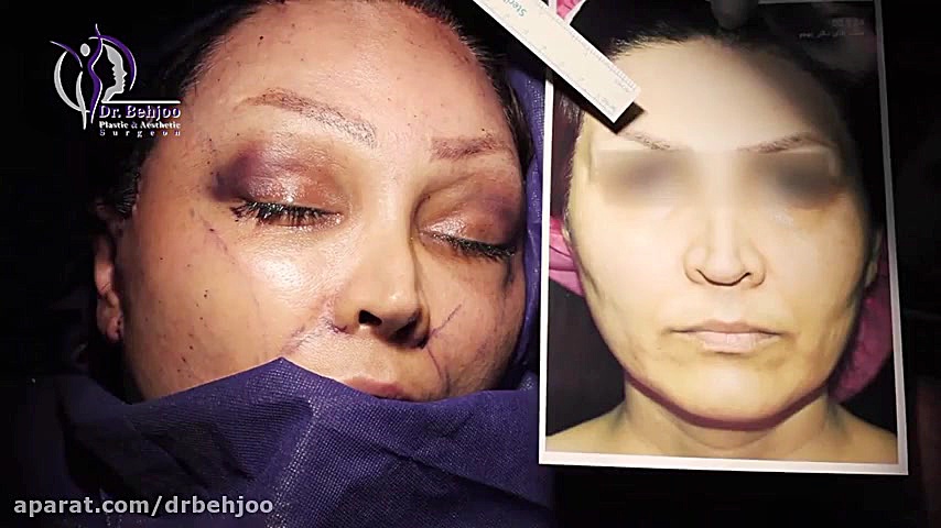فیلم جراحی لیفت صورت در اتاق عمل با اندوسکوپی (3) دکتر شاهین بهجو - فوق تخصص جراحی پلاستیک