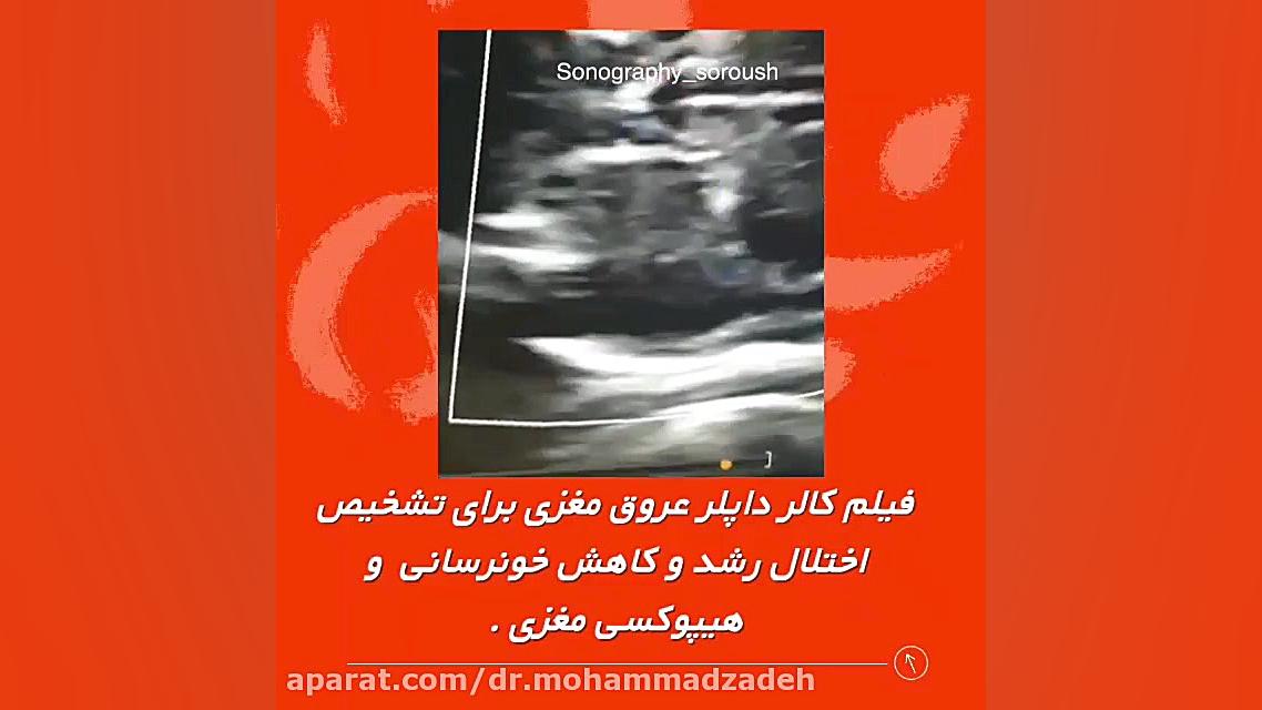 فیلم کاهش خونرسانی و هیپوکسی مغز کلینیک مو