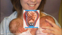 تجویز کورتون به مادر باردار بر...