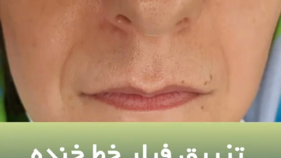 تزریق فیلر خط خنده دکتر ایمان روغنی جراح و متخصص پوست و مو