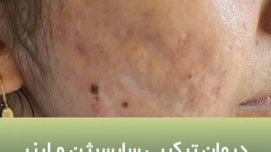 درمان ترکیبی لیزر و سابسیژن دکتر ایمان روغنی جراح و متخصص پوست و مو