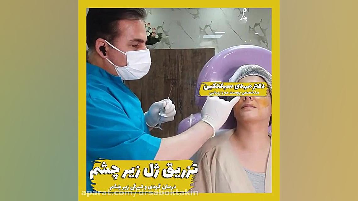 درمان تیرگی و گودی زیر چشم با تزریق فیلر(ژل) متخصص پوست اصفهان دکتر مهدی سبکتکین