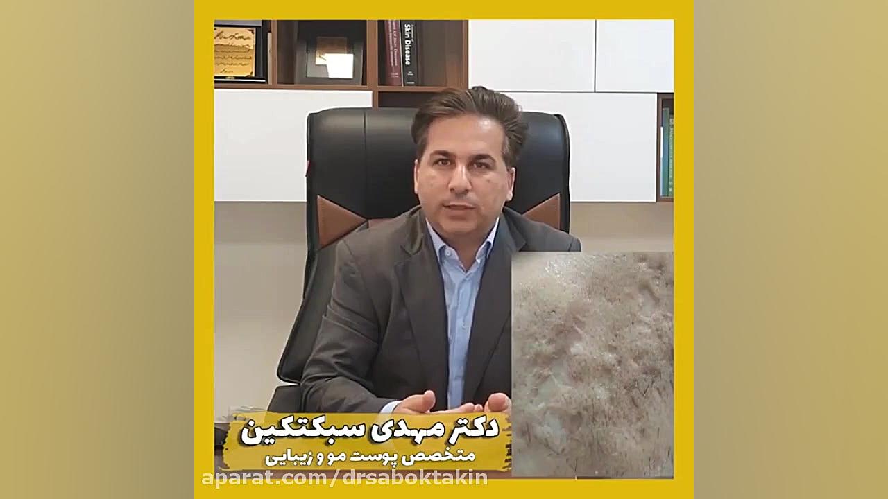 اسکار آکنه چیست؟ / متخصص پوست اصفهان دکتر مهدی سبکتکین متخصص پوست اصفهان دکتر مهدی سبکتکین