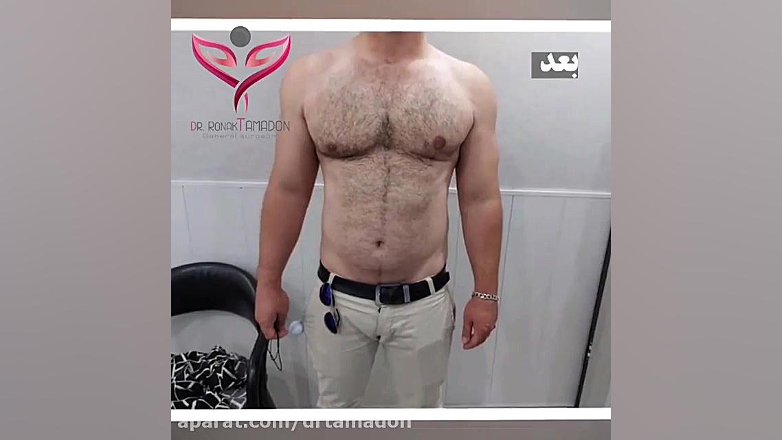 فیلم جراحی ژنیکوماستی کوچک کردن سینه آقایان ترمیم دندان