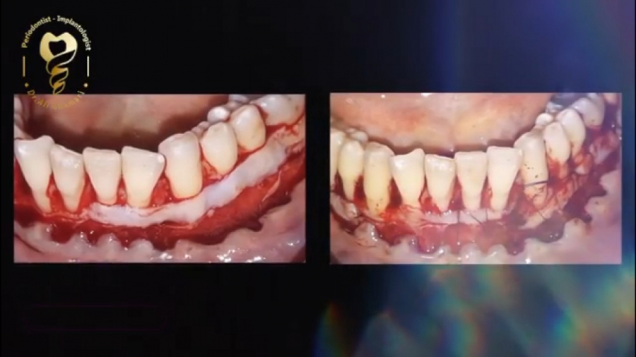 فیلم واقعی جراحی پیوند لثه دکتر علی قمری - متخصص جراحی لثه و ایمپلنت