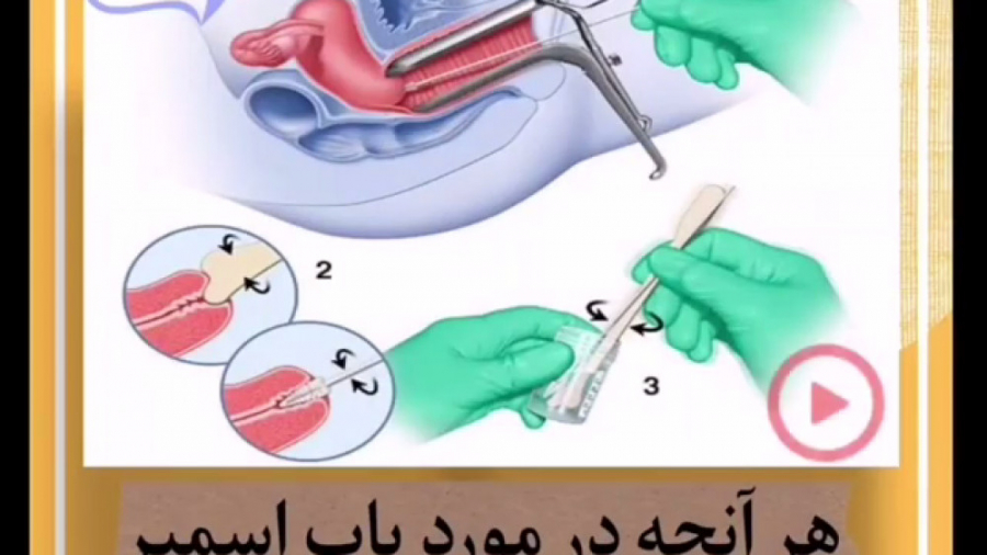 هر آنچه باید در مورد پاپ اسمیر بدانید ترمیم لبخند لثه‌ای