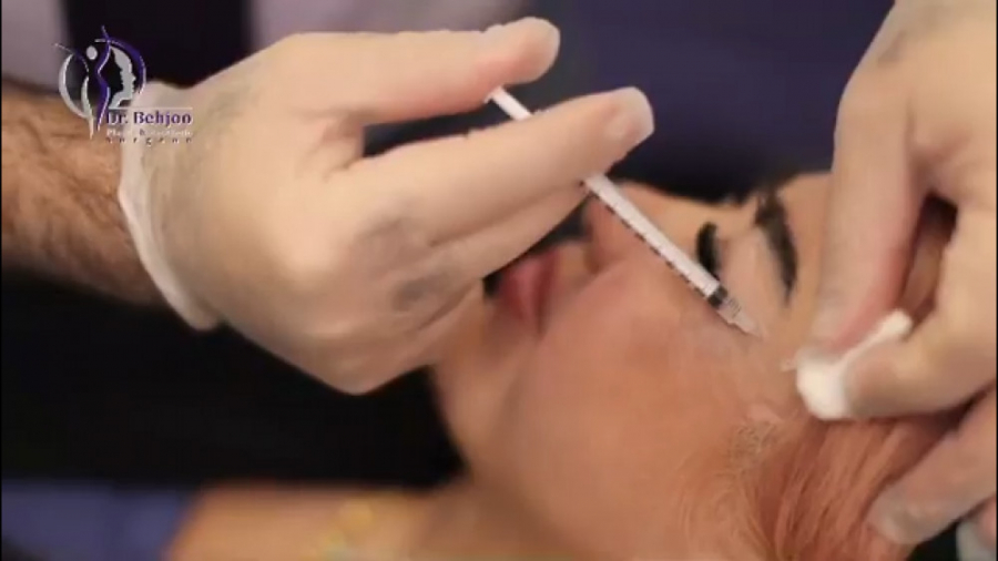 فیلم واقعی تزریق بوتاکس پیشانی دکتر شاهین بهجو - فوق تخصص جراحی پلاستیک