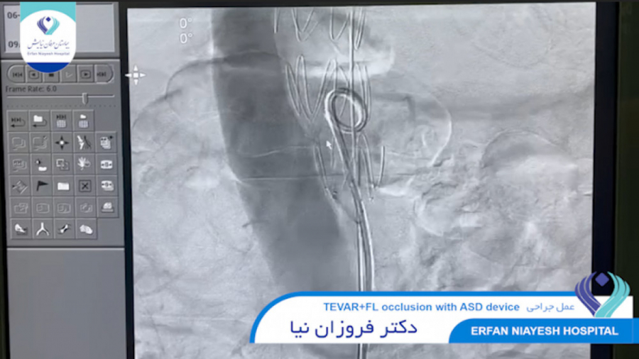 1400.06.23 - عمل جراحي TEVAR FL occlusion with ASD device Fluorescence Lifetime Imaging
