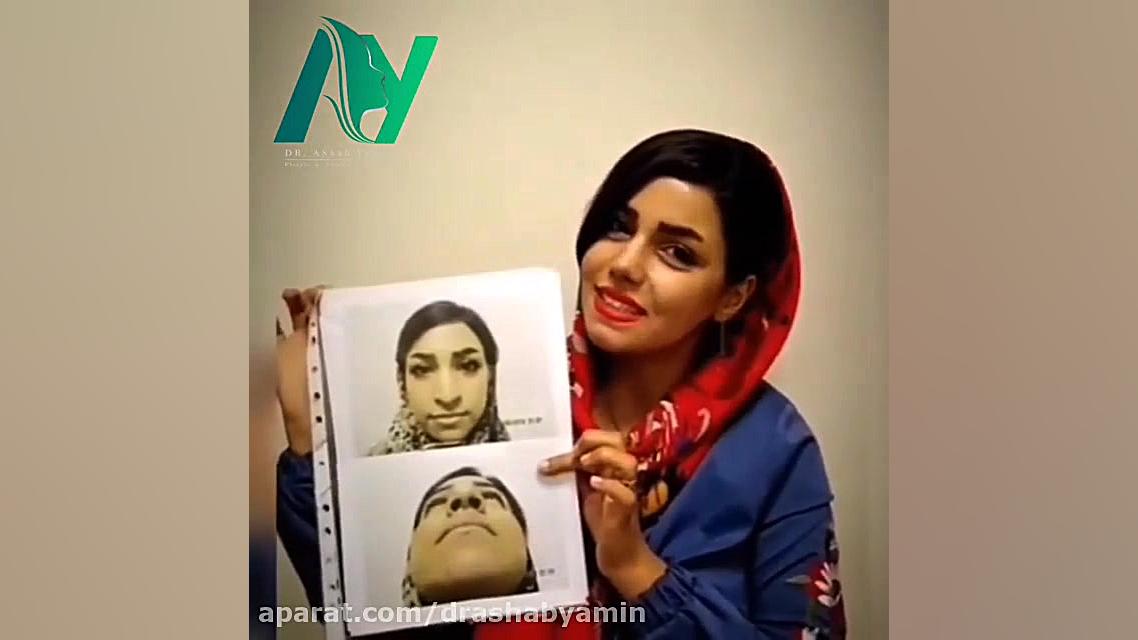 نتیجه جراحی بینی بعد از دو ماه چگونه است؟ دکتر محمودرضا اصحاب یمین - فوق تخصص پلاستیک